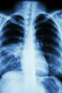 La VAP (ventilator-associated pneumonia)